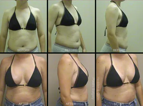 Breast Augmentation Before and Afters with Tops