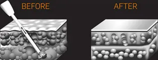 Diagram of skin before and after Smartlipo